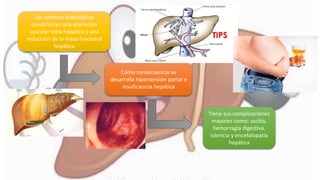 Los cambios histológicos
condicionan una alteración
vascular intra hepática y una
reducción de la masa funcional
hepática
Como consecuencia se
desarrolla hipertensión portal e
insuficiencia hepática
Tiene sus complicaciones
mayores como: ascitis,
hemorragia digestiva,
ictericia y encefalopatía
hepática
 