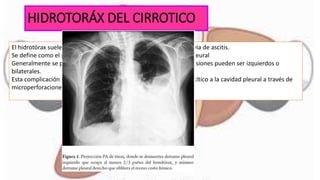 HIDROTORÁX DEL CIRROTICO
El hidrotórax suele aparecer en pacientes cirróticos con historia previa de ascitis.
Se define como el paso masivo de líquido ascítico hacia la cavidad pleural
Generalmente se producen en el hemitórax derecho, aunque en ocasiones pueden ser izquierdos o
bilaterales.
Esta complicación se produce a consecuencia del paso de líquido ascítico a la cavidad pleural a través de
microperforaciones a nivel del diafragma.
 