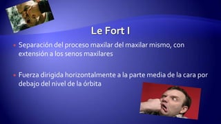  Separación del proceso maxilar del maxilar mismo, con
extensión a los senos maxilares
 Fuerza dirigida horizontalmente a la parte media de la cara por
debajo del nivel de la órbita
 