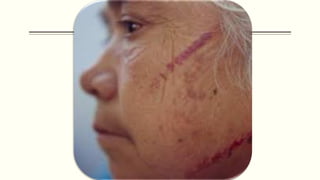 Herida contusa
 Se produce cuando el agente contundente vence el “índice de elasticidad” de la piel que es de 2 a 3 kg po...