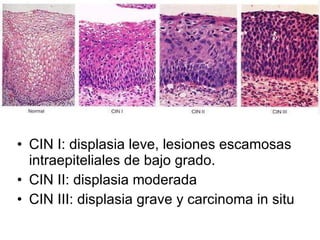 CIN I: displasia leve, lesiones escamosas intraepiteliales de bajo grado. CIN II: displasia moderada CIN III: displasia grave y carcinoma in situ 