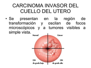 CARCINOMA INVASOR DEL CUELLO DEL UTERO Se presentan en la regi ón de transformación y oscilan de focos microscópicos y a tumores visibles a simple vista. 