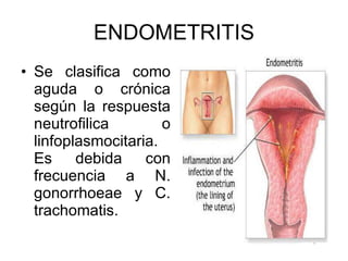 ENDOMETRITIS Se clasifica como aguda o crónica según la respuesta neutrofilica o linfoplasmocitaria. Es debida con frecuencia a N. gonorrhoeae y C. trachomatis. 