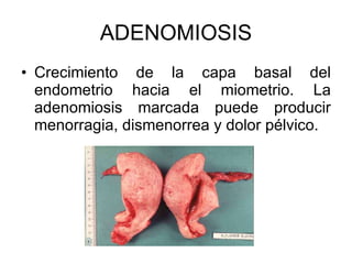 ADENOMIOSIS Crecimiento de la capa basal del endometrio hacia el miometrio. La adenomiosis marcada puede producir menorragia, dismenorrea y dolor pélvico. 