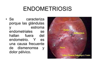 ENDOMETRIOSIS Se caracteriza porque las glándulas y estroma endometriales se hallan fuera del endometrio. Y es una causa frecuente de dismenorrea y dolor pélvico. 