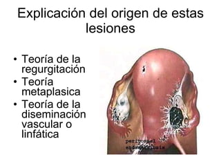 Explicación del origen de estas lesiones Teoría de la regurgitación Teoría metaplasica Teoría de la diseminación vascular o linfática 
