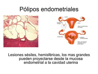 Pólipos endometriales Lesiones sésiles, hemisféricas, los mas grandes pueden proyectarse desde la mucosa endometrial a la cavidad uterina 