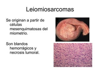 Leiomiosarcomas Se originan a partir de células mesenquimatosas del miometrio. Son blandos hemorrágicos y necrosis tumoral. 