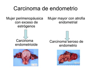 Carcinoma de endometrio Mujer perimenopáusica con exceso de estrógenos Carcinoma endometrioide Mujer mayor con atrofia endometrial Carcinoma seroso de endometrio 