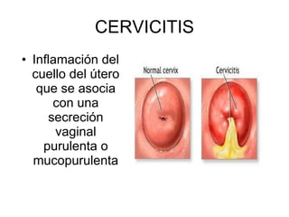 CERVICITIS Inflamación del cuello del útero que se asocia con una secreción vaginal purulenta o mucopurulenta 