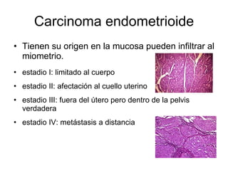 Carcinoma endometrioide Tienen su origen en la mucosa pueden infiltrar al miometrio. estadio I: limitado al cuerpo estadio II: afectación al cuello uterino estadio III: fuera del útero pero dentro de la pelvis verdadera estadio IV: metástasis a distancia  