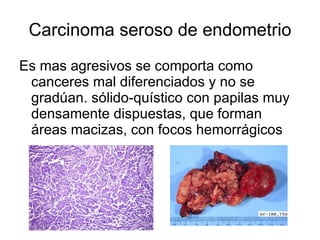 Carcinoma seroso de endometrio Es mas agresivos se comporta como canceres mal diferenciados y no se gradúan. sólido-quístico con papilas muy densamente dispuestas, que forman áreas macizas, con focos hemorrágicos  