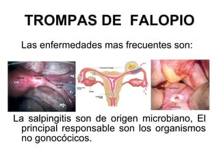 TROMPAS DE  FALOPIO Las enfermedades mas frecuentes son: La salpingitis son de origen microbiano, El principal responsable son los organismos no gonocócicos.  