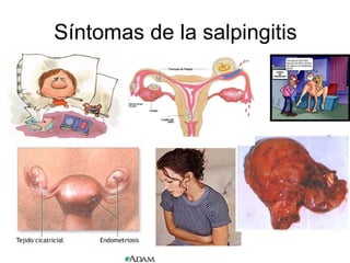 Síntomas de la salpingitis 