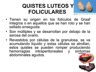 QUISTES LUTEOS Y FOLICULARES   Tienen su origen en los folículos de Graaf íntegros o en aquellos que se han roto y se han sellado enseguida. Son múltiples y se desarrollan por debajo de la serosa del ovario. Revestidos por células de la granulosa, se va acumulando liquido y estas células se atrofian, estos quistes se pueden romper produciendo hemorragias intraperitoneales y síntomas abdominales agudos. 