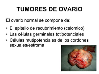 TUMORES DE OVARIO El ovario normal se compone de: El epitelio de recubrimiento (celomico) Las células germinales totipotenciales Células mutipotenciales de los cordones sexuales/estroma 