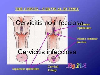 Cervicitis no infecciosa Cervicitis infecciosa Cervicitis no infecciosa Cervicitis infecciosa 
