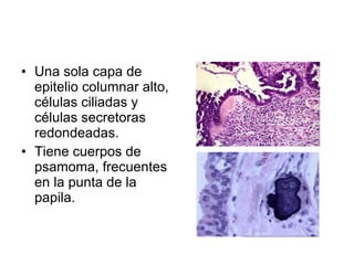 Una sola capa de epitelio columnar alto, células ciliadas y células secretoras redondeadas. Tiene cuerpos de psamoma, frecuentes en la punta de la papila. 