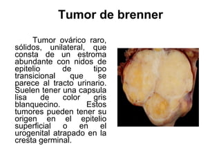Tumor de brenner Tumor ovárico raro, sólidos, unilateral, que consta de un estroma abundante con nidos de epitelio de tipo transicional que se parece al tracto urinario. Suelen tener una capsula lisa de color gris blanquecino. Estos tumores pueden tener su origen en el epitelio superficial o en el urogenital atrapado en la cresta germinal.  