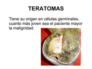 TERATOMAS Tiene su origen en células germinales, cuanto más joven sea el paciente mayor la malignidad. 