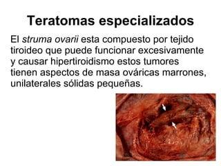 Teratomas especializados El  struma ovarii  esta compuesto por tejido tiroideo que puede funcionar excesivamente y causar hipertiroidismo estos tumores tienen aspectos de masa ováricas marrones, unilaterales sólidas pequeñas. 