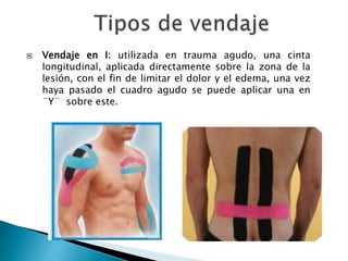  Vendaje en I: utilizada en trauma agudo, una cinta
longitudinal, aplicada directamente sobre la zona de la
lesión, con el fin de limitar el dolor y el edema, una vez
haya pasado el cuadro agudo se puede aplicar una en
¨Y¨ sobre este.
 