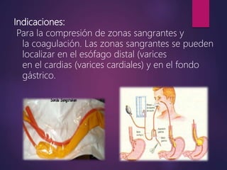 Indicaciones:
Para la compresión de zonas sangrantes y
la coagulación. Las zonas sangrantes se pueden
localizar en el esófago distal (varices
en el cardias (varices cardiales) y en el fondo
gástrico.
 