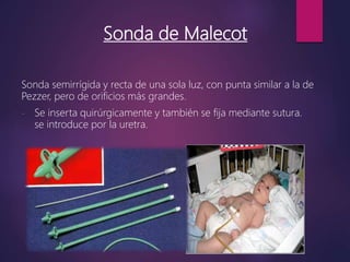 Sonda de Malecot
Sonda semirrígida y recta de una sola luz, con punta similar a la de
Pezzer, pero de orificios más grandes.
- Se inserta quirúrgicamente y también se fija mediante sutura.
se introduce por la uretra.
 