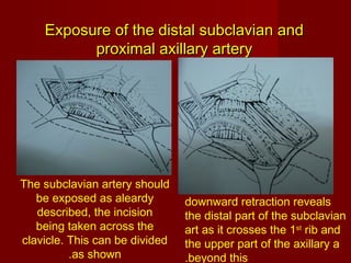 Exposure of major blood vessels | PPT