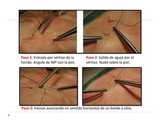 Paso 1: Entrada por vértice de la
herida. Angulo de 90º con la piel.
Paso 2: Salida de aguja por el
vértice. Nudo sobre la piel.
Paso 3: Iremos avanzando en sentido horizontal de un borde a otro.
 