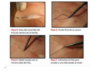 Paso 4: Vista del recorrido del
hilo por dentro de la herida.
Paso 5: Punto final de la sutura.
Paso 6 :Doble lazada con el
mismo cabo del hilo.
Paso 7: Estiramos el hilo para
anudar y una 2da lazada al revés
 
