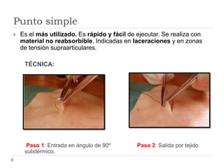 Punto simple
 Es el más utilizado. Es rápido y fácil de ejecutar. Se realiza con
material no reabsorbible. Indicadas en laceraciones y en zonas
de tensión supraarticulares.
TÉCNICA:
Paso 1: Entrada en ángulo de 90º Paso 2: Salida por tejido
subdérmico.
 