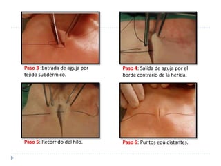 Paso 3 :Entrada de aguja por
tejido subdérmico.
Paso 4: Salida de aguja por el
borde contrario de la herida.
Paso 5: Recorrido del hilo. Paso 6: Puntos equidistantes.
 