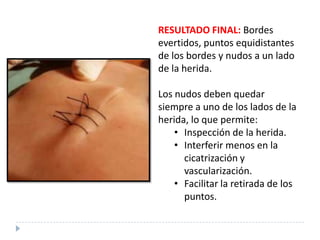 RESULTADO FINAL: Bordes
evertidos, puntos equidistantes
de los bordes y nudos a un lado
de la herida.
Los nudos deben quedar
siempre a uno de los lados de la
herida, lo que permite:
• Inspección de la herida.
• Interferir menos en la
cicatrización y
vascularización.
• Facilitar la retirada de los
puntos.
 
