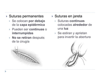  Suturas permanentes
 Se colocan por debajo
de la capa epidérmica
 Pueden ser continuas o
interrumpidas
 No se retiran después
de la cirugía
 Suturas en jareta
 Suturas continuas
colocadas alrededor de
una luz
 Se estiran y aprietan
para invertir la abertura
 