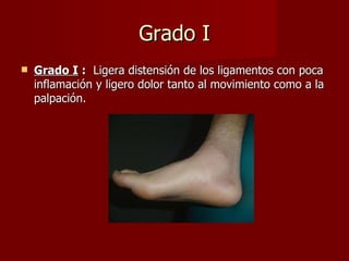 Grado I Grado I  :   Ligera distensión de los ligamentos con poca inflamación y ligero dolor tanto al movimiento como a la palpación. 