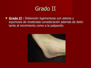 Grado II Grado II  :  Distensión ligamentosa con edema y equimosis de moderada consideración además de dolor tanto al movimiento como a la palpación. 