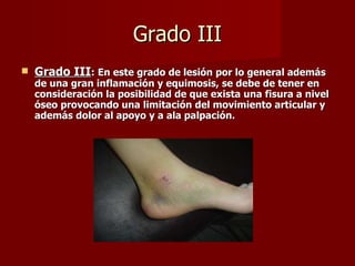 Grado III Grado III :   En este grado de lesión por lo general además de una gran inflamación y equimosis, se debe de tener en consideración la posibilidad de que exista una fisura a nivel óseo provocando una limitación del movimiento articular y además dolor al apoyo y a ala palpación. 