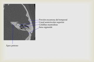 Porción escamosa del temporal
Canal semicircular superior
Celdillas mastoideas
Seno sigmoide
Ápex petroso
 