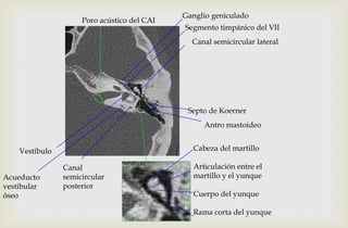 Acueducto
vestibular
óseo
Vestíbulo
Canal
semicircular
posterior
Poro acústico del CAI
Canal semicircular lateral
Antro mastoideo
Ganglio geniculado
Segmento timpánico del VII
Septo de Koerner
Cabeza del martillo
Articulación entre el
martillo y el yunque
Cuerpo del yunque
Rama corta del yunque
 