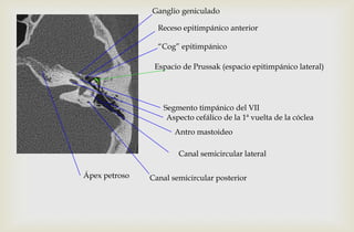 Receso epitimpánico anterior
“Cog” epitimpánico
Ganglio geniculado
Segmento timpánico del VII
Aspecto cefálico de la 1ª vuelta de la cóclea
Canal semicircular posteriorÁpex petroso
Antro mastoideo
Espacio de Prussak (espacio epitimpánico lateral)
Canal semicircular lateral
 
