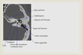 Fóvea del acueducto
vestibular óseo
Septo de Koerner
Ápex petroso
CAI
Vestíbulo
Antro mastoideo
Seno sigmoide
Epitímpano
Espacio de Prussak
 