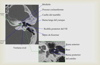 Ventana oval
Modiolo
Proceso cocleariforme
Cuello del martillo
Rama larga del yunque
Rodilla posterior del VII
endón del m.
ensor del
ímpano
Apertura
coclear
Septo de Koerner
del estribo
Rama anterior
Base
Rama posterior
 