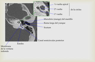 Membrana
de la ventana
redonda
Scutum
Manubrio (mango) del martillo
Rama larga del yunque
Estribo
Canal semicircular posterior
½ vuelta apical
2ª vuelta
1ª vuelta
de la cóclea
 