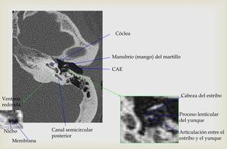 Ventana
redonda
Manubrio (mango) del martillo
Canal semicircular
posterior
CAE
Proceso lenticular
del yunque
Articulación entre el
estribo y el yunque
Cabeza del estribo
Cóclea
Membrana
Nicho
 