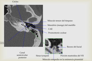 Manubrio (mango) del martillo
CAE
Músculo tensor del tímpano
Cóclea
Promontorio coclear
Canal
semicircular
posterior
Ventana
redonda
Sinus tympani
Músculo estapedio en la eminencia piramidal
Receso del facial
Porción mastoidea del VII
 