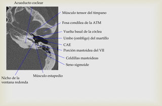 Umbo (ombligo) del martillo
Porción mastoidea del VII
Músculo estapedio
Vuelta basal de la cóclea
CAE
Nicho de la
ventana redonda
Músculo tensor del tímpano
Seno sigmoide
Acueducto coclear
Celdillas mastoideas
Fosa condilea de la ATM
 