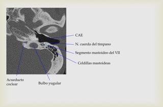 N. cuerda del tímpano
Segmento mastoideo del VII
Bulbo yugular
Acueducto
coclear
Celdillas mastoideas
CAE
 