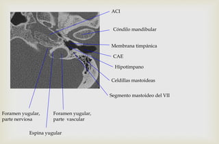 Membrana timpánica
Hipotímpano
Foramen yugular,
parte nerviosa
Espina yugular
Foramen yugular,
parte vascular
ACI
Cóndilo mandibular
Segmento mastoideo del VII
Celdillas mastoideas
CAE
 
