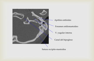 Apófisis estiloides
Foramen estilomastoideo
V. yugular interna
Canal del hipogloso
Sutura occipito-mastoidea
 